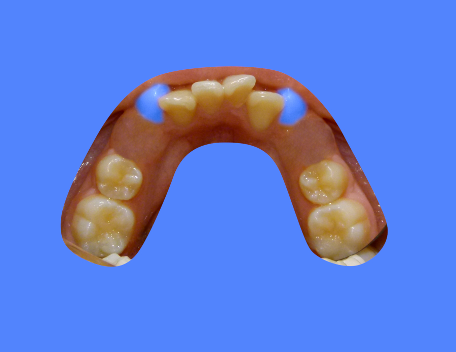 After image showing patient with misaligned teeth